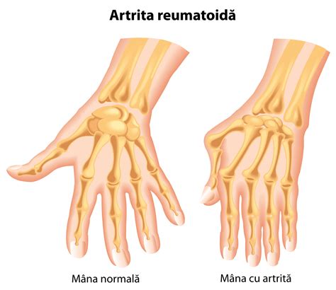 durere deasupra genunchiului în față la îndoire Tratamentul inflamației articulațiilor mâinilor